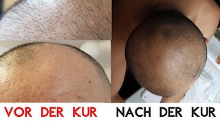 New Hairz - Neue Haare ohne Transplantation - Der lebendige Beweis - Mit Vorher - Nachher Bildern