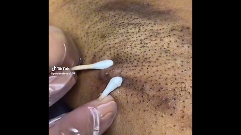 Underarm Ingrown Hair Blackheads