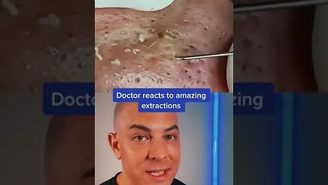 Doctor reacts to an amazing pimple extraction! #pimplepop #skinextraction #satisfying #dermreacts