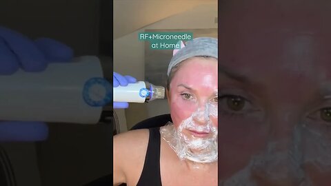 RF+ Microneedling #shorts