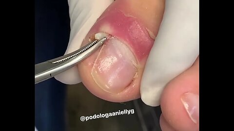 unha encravada, retira de espícula | ingrown toenail, remove the spike #nails #toenails #podiatrist