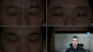 THE XANTHELASMA REMOVED WITHOUT TCA