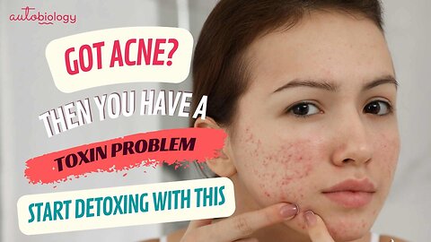 I wish someone would have told me THIS about Acne 20 years ago