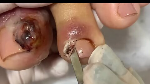Unhas encravadas com granuloma | Ingrown toenails with granuloma #nails #podologia