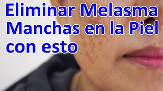 LA CAUSA Y EL REMEDIO PARA EL MELASMA (EL PAÑO O CLOASMA) MANCHAS EN LA PIEL - HIPERPIGMENTACIÓN