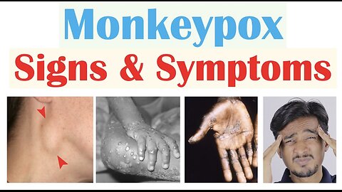 Monkeypox Signs & Symptoms (First Symptom & Stages of Rash)