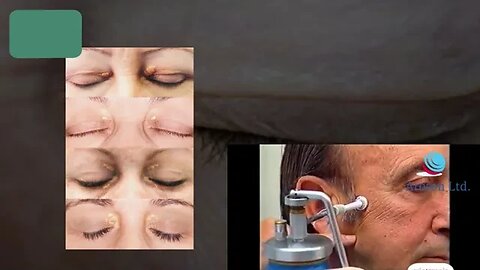 CRYOTHERAPY FOR XANTHELASMA REMOVAL