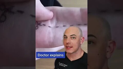 Doctor explains fused fingers! #fusedfingers #skin #doctorreacts #dermreacts