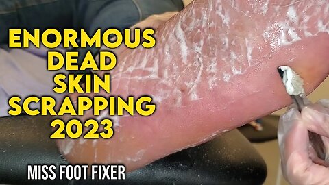 ENORMOUS! DEAD SKIN & CALLOUS SCRAPPING FROM SOLE OF FEET [2023] BY FOOT SPECIALIST MISS FOOT FIXER