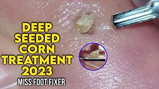 2023 - Podiatrist Removes Painful Deep Seeded Corn From Sole Of Feet [ MISS FOOT FIXER ]
