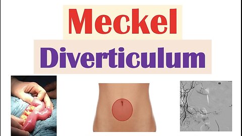 Meckel Diverticulum (Intestinal Anomaly) | Causes, Symptoms & Complications, Diagnosis, Treatment