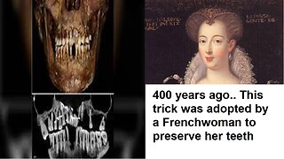 400 years ago.. This trick was adopted by a Frenchwoman to preserve her teeth