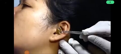 Removing a snake from a woman ear