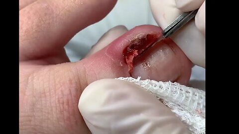 Unha do dedão encravada por corte incorreto | Ingrown toenail due to incorrect cut #nails #podologia