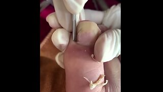 UNHA ENCRAVADA SATISFATÓRIO PEDICURE LIMPEZA RELAX 1 #podologia #ingrowntoenail #naillovers