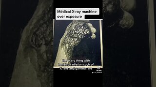 Medical X-ray over exposure