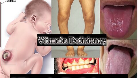 Vitamins and Associated Diseases: A Quick Reference Guide :