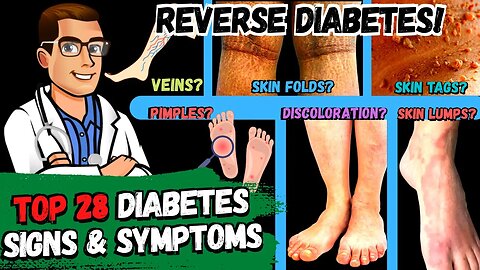 28 Diabetes Signs & Symptoms [REVERSE DIABETES + 2 BIG SECRETS!]