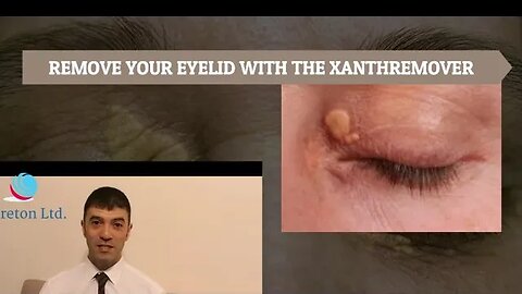 REMOVE YOUR EYELID WITH THE XANTHREMOVER