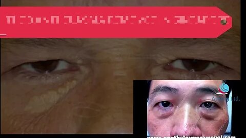 THE XANTHELASMA REMOVED IN SINGAPORE