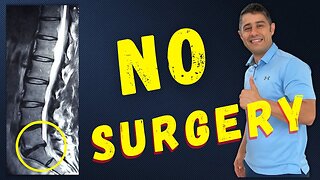 Lumbar Disc Bulges L5 S1 recovery without surgery