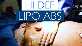 Hi Def Liposuction | Abdomen Transformation | Lipo + Etching