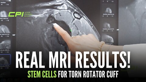 Doctor Reviews Stem Cell Results for Rotator Cuff Injury at CPI