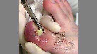 Remoção de unha encravada asmr | ingrown toenail removal asmr #nails #podologia #toenails