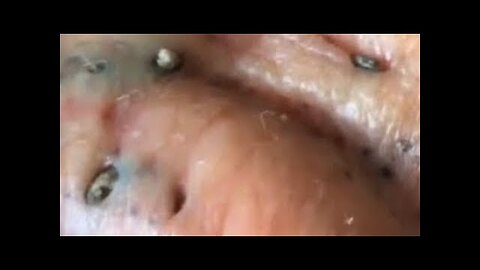 Big Cystic Acne Blackheads Extraction Blackheads and Whiteheads Removal Pimple Popping