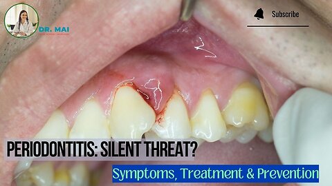 Silent Gum Disease Threat! Periodontitis Symptoms & Treatment
