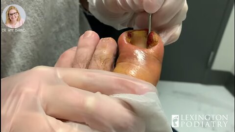 WE'RE THANKFUL FOR THIS EPIC INGROWN | HAPPY THANKSGIVING Y'ALL