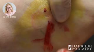 EXPLOSIVE CYST POP | It Just Keeps Coming!