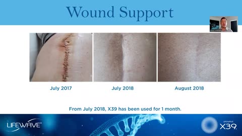 David Schmidt X39 wound healing