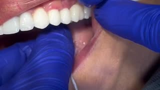 Flossing with a dental bridge
