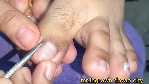 Ingrown nail removal