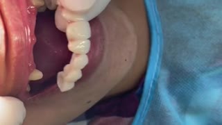 Teeth set-up