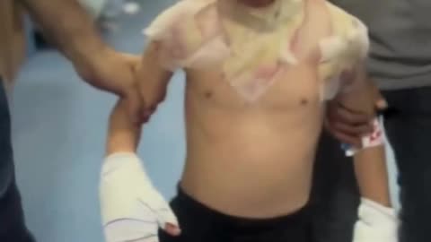 A young Palestinian boy is treated for severe burns as a result of Israeli missiles