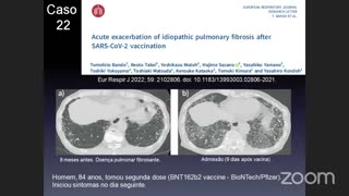 Aula do Dr Marchiori: exacerbação pneumonia intersticial após vacina da covid