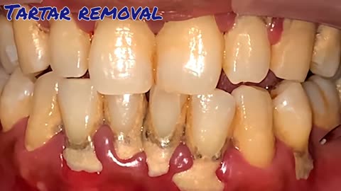Teeth Cleaning | Scaling Of Teeth | Tartar Removal