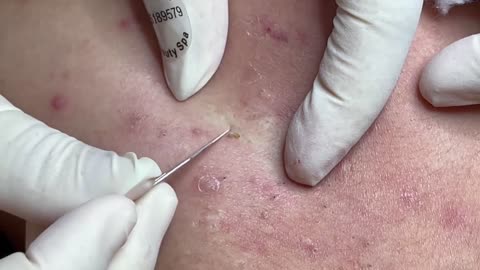 Acne Blackhead, Spot Removal