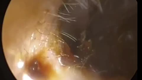 Ear Wax Removal