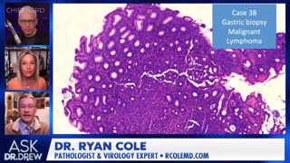 What’s inside of every cancer cell? Spike protein. Every malignant B-cell has spike protein in it.