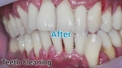 Scaling Of Teeth | Tartar Removal