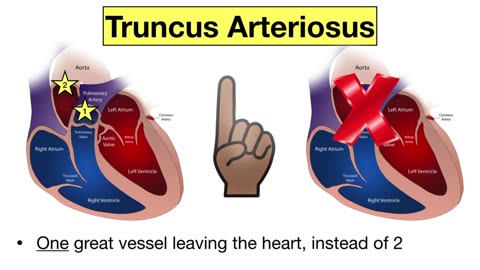 EASY TRICK to Learn Congenital Heart Defects & Diseases [Pediatrics, Nursing, USMLE]
