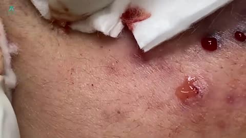 Big Cystic Acne Blackheads Extraction Blackheads and Whiteheads Removal Pimple Popping
