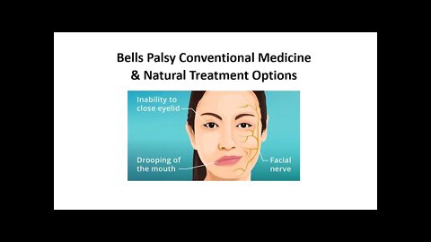 Bells Palsy Treatment Options Conventional & Natural