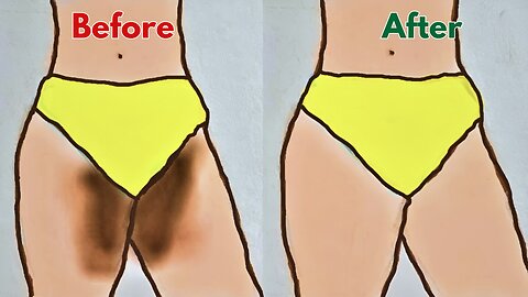How to lighten Dark Inner Thighs FAST and NATURALLY | Dark inner thighs: causes and treatments