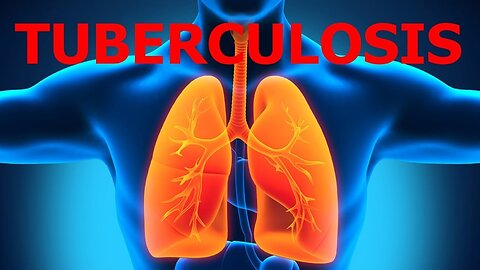 COMO CURAR LA TUBERCULOSIS CON REMEDIOS NATURALES EFECTIVOS CAUSAS EMOCIONALES BIODESCODIFICACION