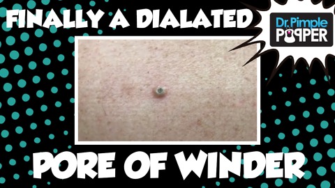 FINALLY, a Dilated Pore of Winder!