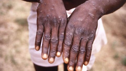First Case of Monkeypox in US This Year - Ramping Up the Fear?
